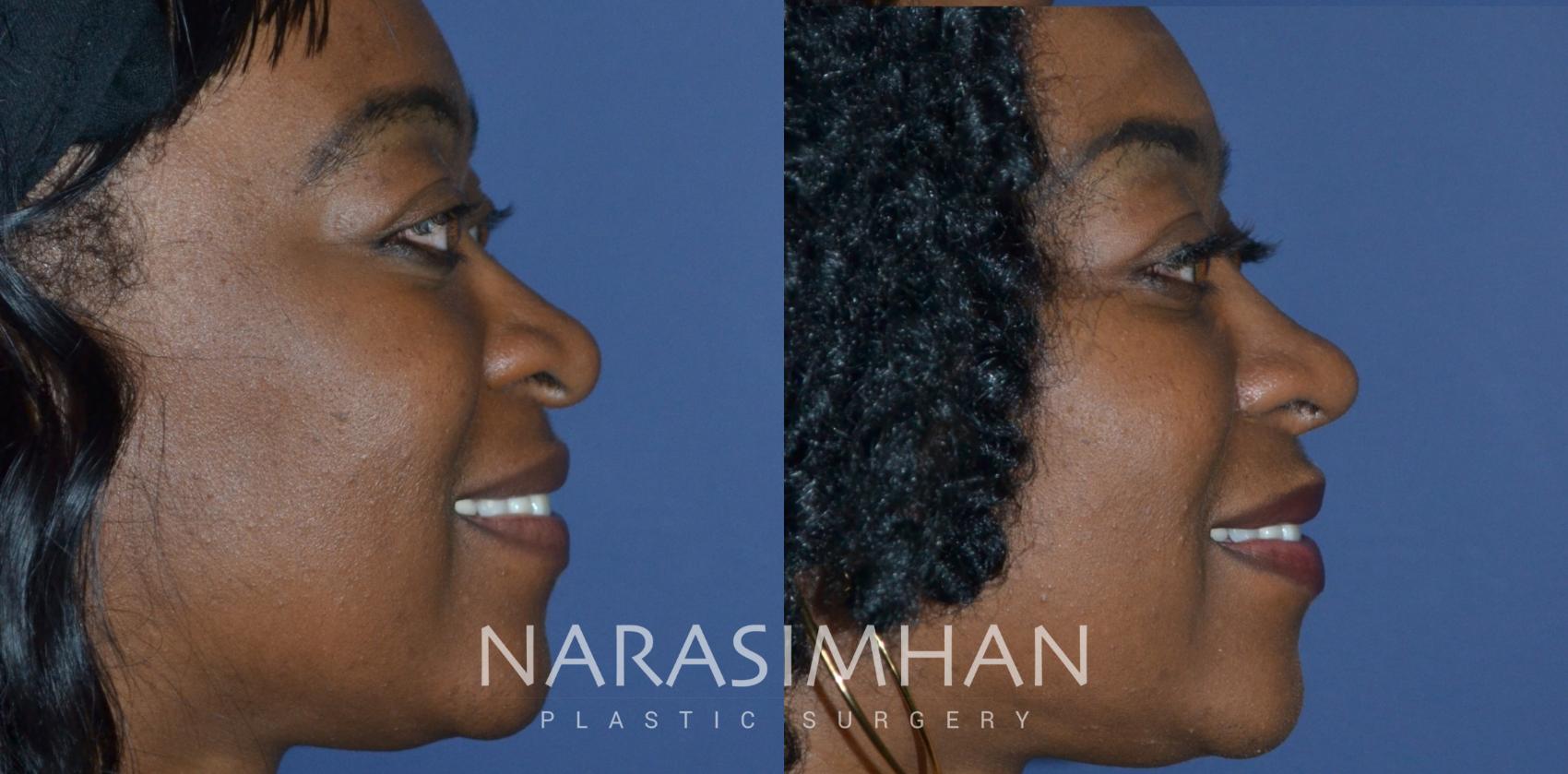 Before & After African American Rhinoplasty Case 301 Right Side View in St Petersburg, Florida