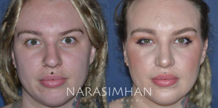 Before & After Rhinoplasty Case 302 Front View in Tampa, Florida
