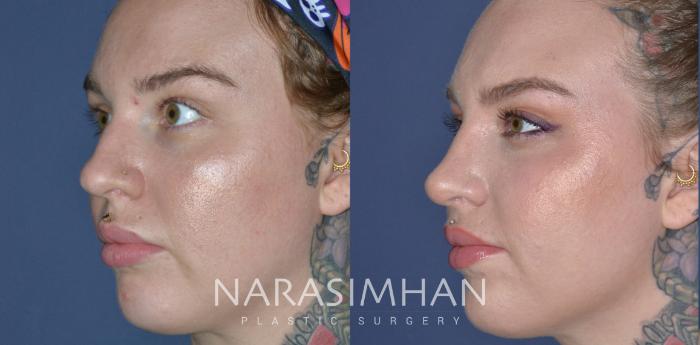 Before & After Rhinoplasty Case 302 Left Oblique View in Tampa, Florida