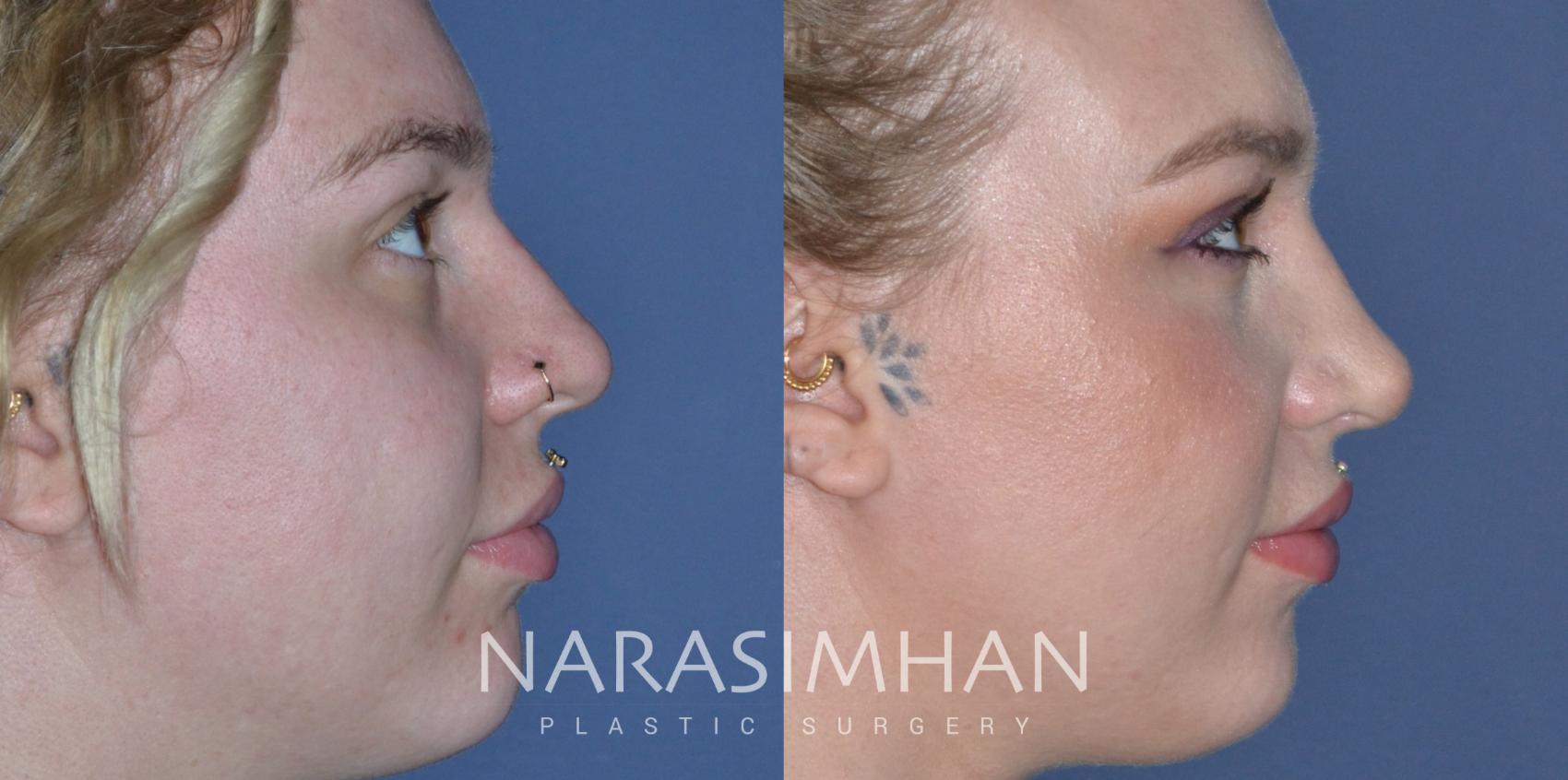 Before & After Rhinoplasty Case 302 Right Side View in Tampa, Florida