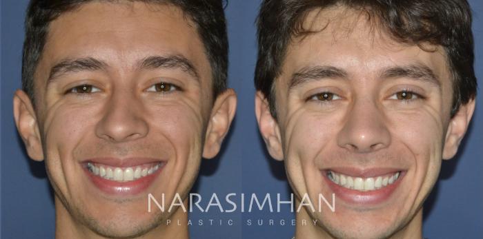 Before & After Ethnic Rhinoplasty Case 303 Front View in Tampa, Florida