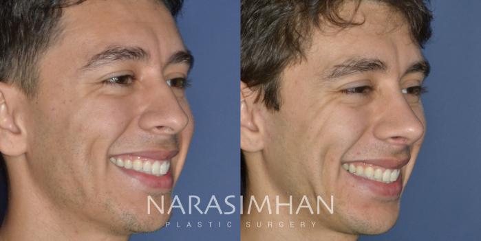 Before & After Ethnic Rhinoplasty Case 303 Right Oblique View in Tampa, Florida