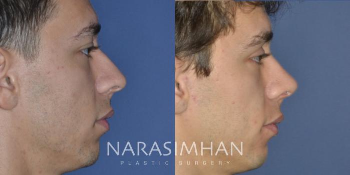 Before & After Ethnic Rhinoplasty Case 303 Right Side View in Tampa, Florida