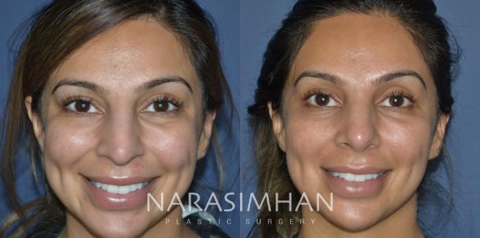 Before & After Ethnic Rhinoplasty Case 304 Front View in Tampa, Florida