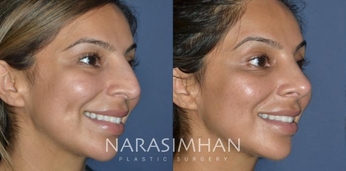 Before & After Rhinoplasty Case 304 Right Oblique View in Tampa, Florida