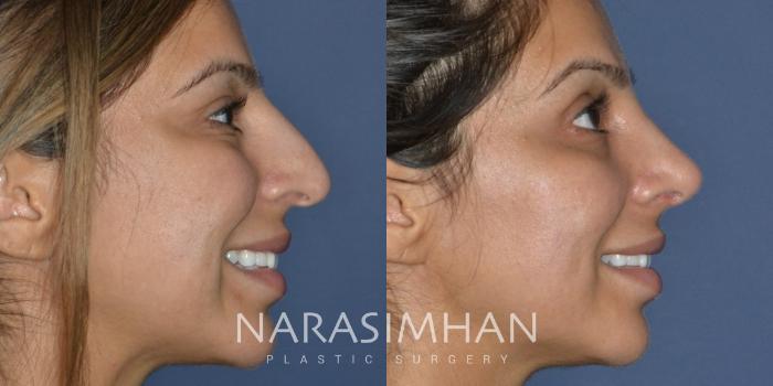 Before & After Rhinoplasty Case 304 Right Side View in Tampa, Florida
