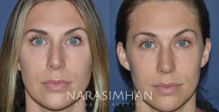 Before & After Revision Rhinoplasty Case 305 Front View in Tampa, Florida
