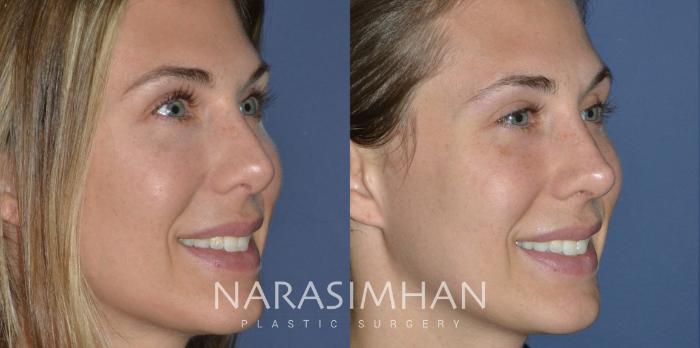 Before & After Revision Rhinoplasty Case 305 Right Oblique View in Tampa, Florida
