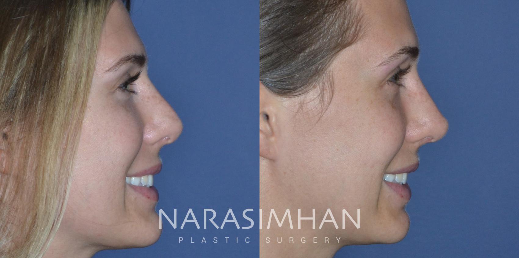 Before & After Rhinoplasty Case 305 Right Side View in Tampa, Florida