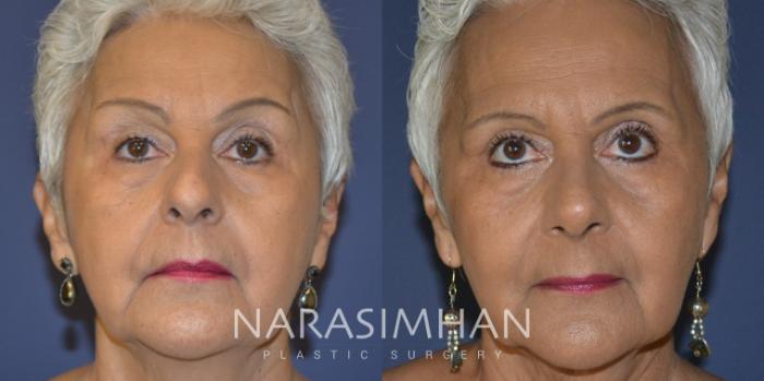 Before & After Rhinoplasty Case 308 Front View in Tampa, Florida