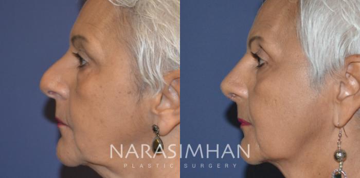 Before & After Rhinoplasty Case 308 Left Side View in Tampa, Florida