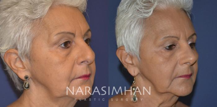 Before & After Rhinoplasty Case 308 Right Oblique View in Tampa, Florida