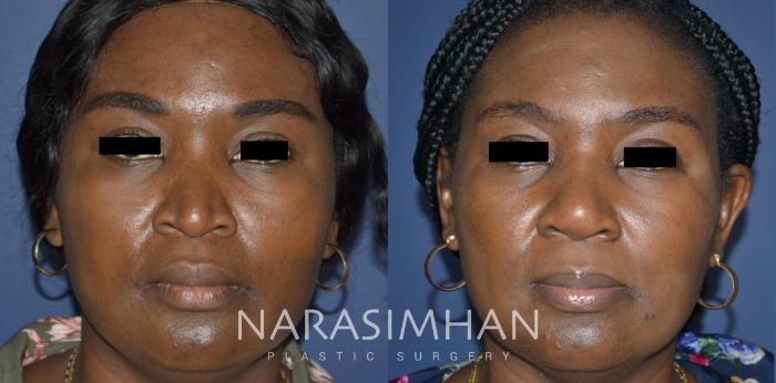 Before & After Rhinoplasty Case 312 Front View in Tampa, Florida