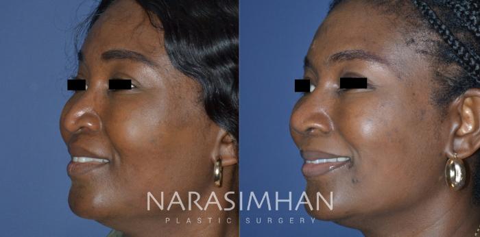 Before & After Rhinoplasty Case 312 Left Oblique View in Tampa, Florida