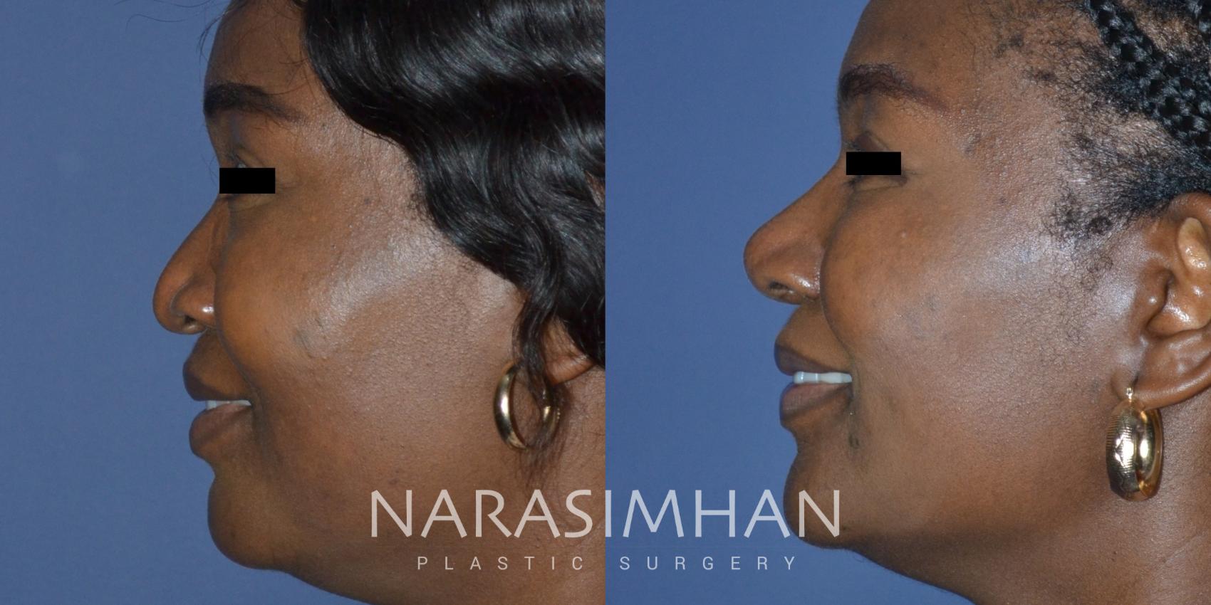 Before & After Rhinoplasty Case 312 Left Side View in Tampa, Florida