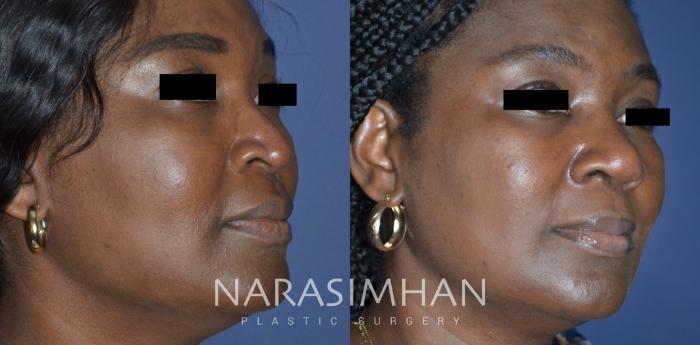 Before & After Rhinoplasty Case 312 Right Oblique View in Tampa, Florida