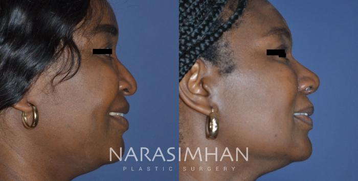 Before & After Rhinoplasty Case 312 Right Side View in Tampa, Florida