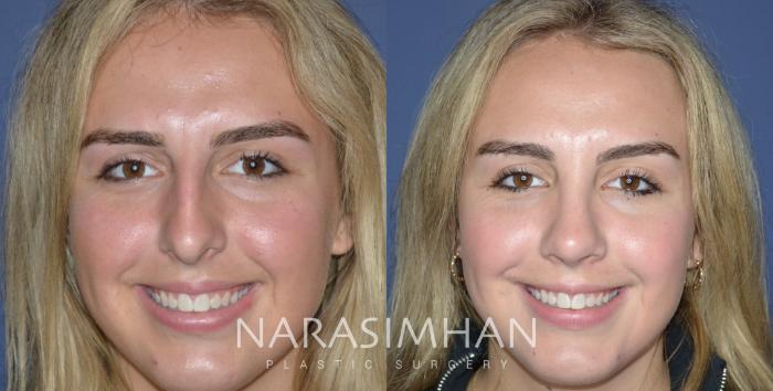 Before & After Rhinoplasty Case 314 Front View in Tampa, Florida