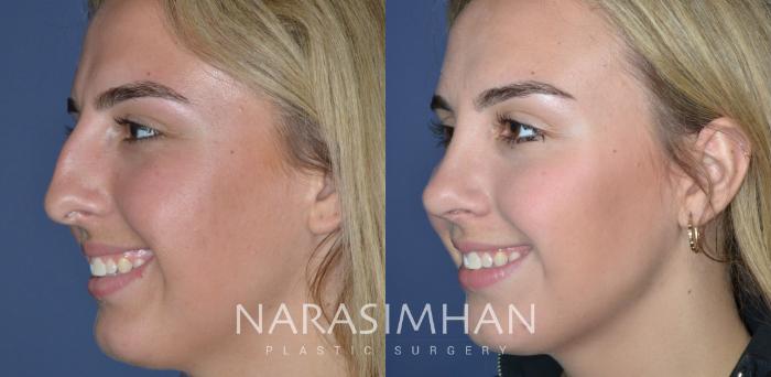 Before & After Rhinoplasty Case 314 Left Oblique View in Tampa, Florida