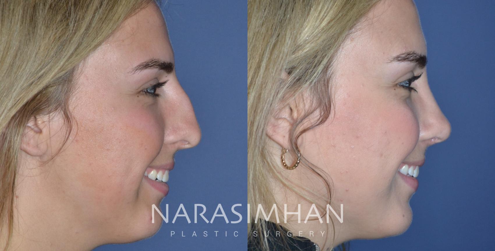 Before & After Rhinoplasty Case 314 Right Side View in Tampa, Florida