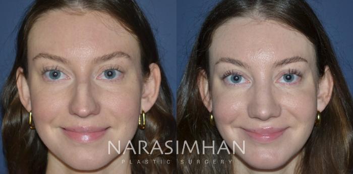 Before & After Rhinoplasty Case 321 Front View in Tampa, Florida