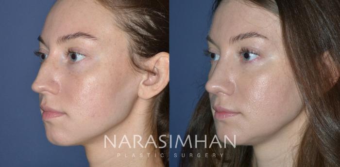 Before & After Rhinoplasty Case 321 Left Oblique View in Tampa, Florida