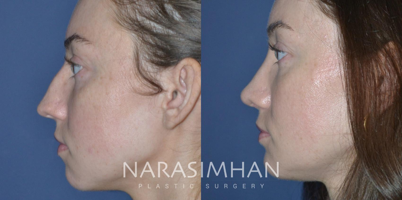 Before & After Rhinoplasty Case 321 Left Side View in Tampa, Florida