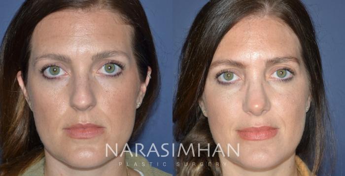 Before & After Rhinoplasty Case 323 Front View in Tampa, Florida