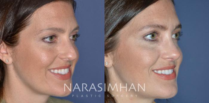 Before & After Rhinoplasty Case 323 Right Oblique View in Tampa, Florida