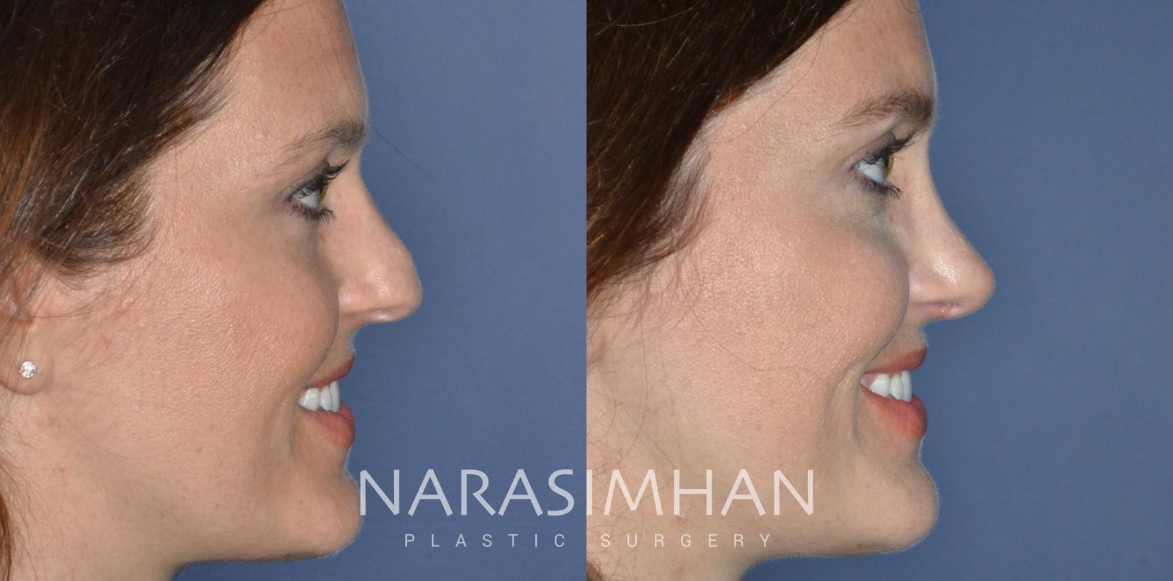 Before & After Rhinoplasty Case 323 Right Side View in Tampa, Florida