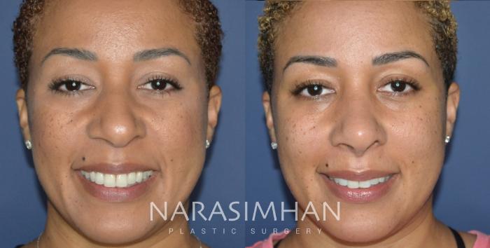Before & After Rhinoplasty Case 324 Front View in Tampa, Florida