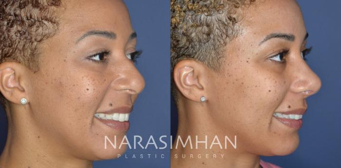 Before & After Rhinoplasty Case 324 Right Oblique View in Tampa, Florida