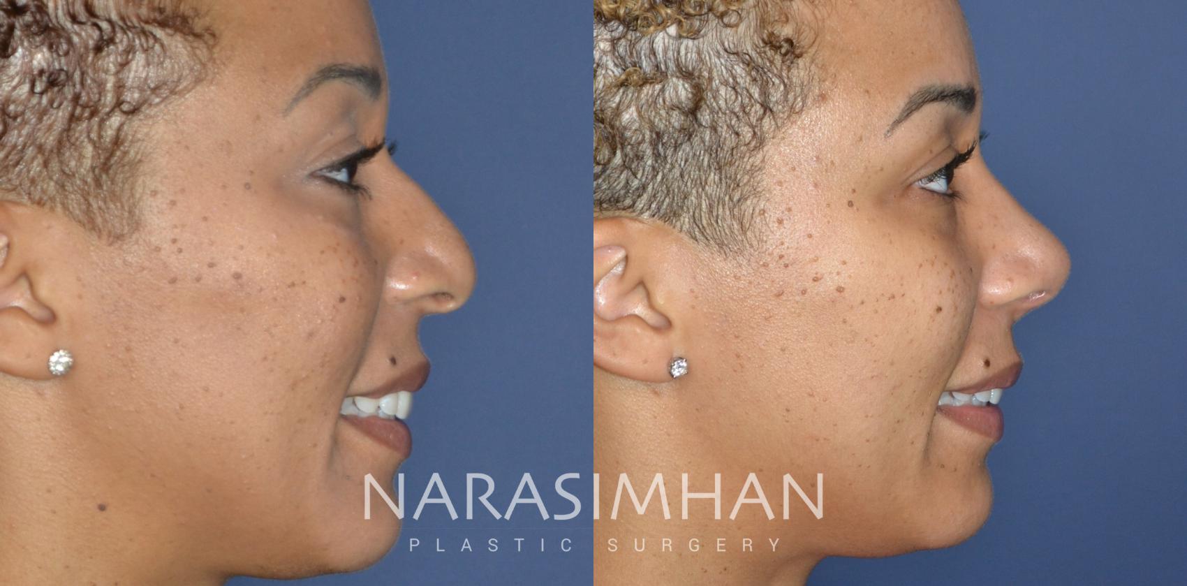 Before & After Rhinoplasty Case 324 Right Side View in Tampa, Florida