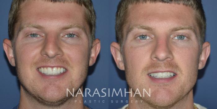 Before & After Rhinoplasty Case 325 Front View in Tampa, Florida