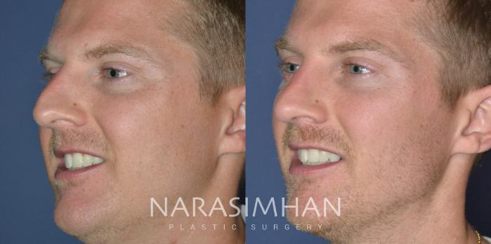 Before & After Rhinoplasty Case 325 Left Oblique View in Tampa, Florida