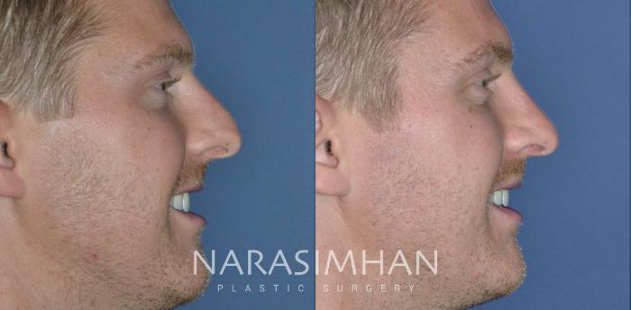 Before & After Rhinoplasty Case 325 Right Side View in Tampa, Florida