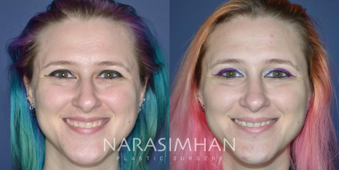 Before & After Rhinoplasty Case 326 Front View in Tampa, Florida