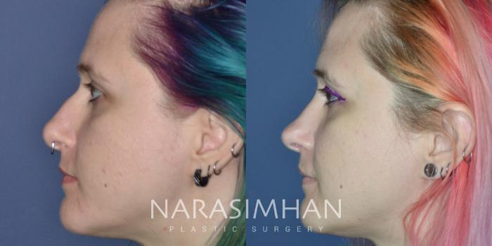 Before & After Rhinoplasty Case 326 Left Side View in Tampa, Florida