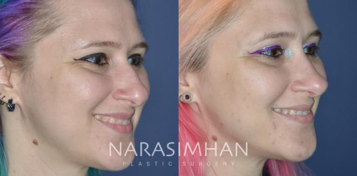 Before & After Rhinoplasty Case 326 Right Oblique View in Tampa, Florida