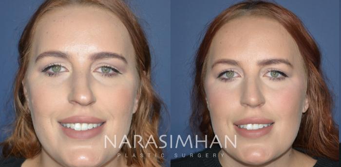 Before & After Rhinoplasty Case 327 Front View in Tampa, Florida