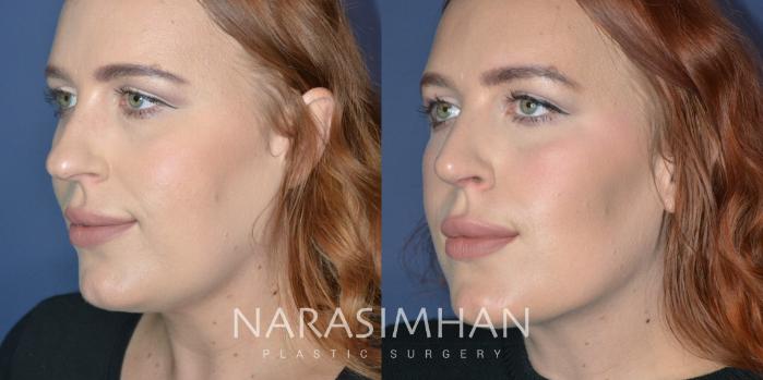 Before & After Rhinoplasty Case 327 Left Oblique View in Tampa, Florida