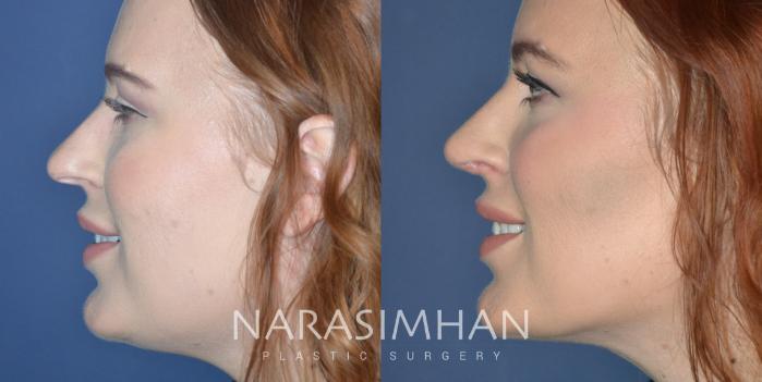 Before & After Liposuction Case 327 Left Side View in Tampa, Florida