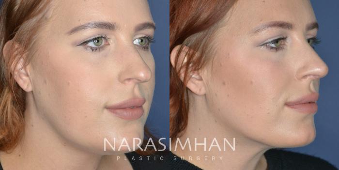 Before & After Rhinoplasty Case 327 Right Oblique View in Tampa, Florida