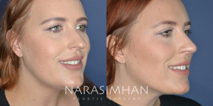 Before & After Rhinoplasty Case 327 Smiling right oblique View in Tampa, Florida