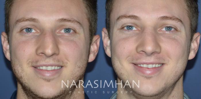 Before & After Rhinoplasty Case 328 Front View in Tampa, Florida