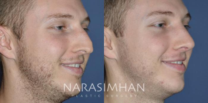 Before & After Rhinoplasty Case 328 Right Oblique View in Tampa, Florida