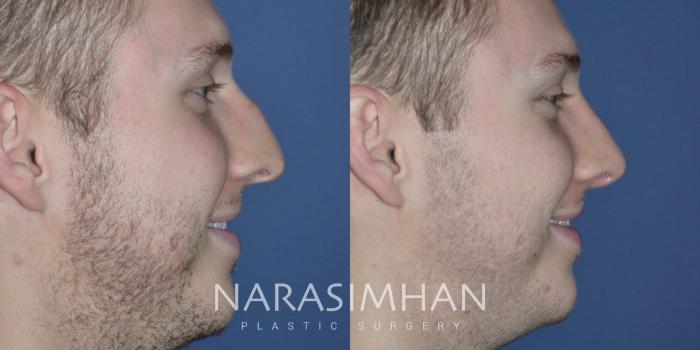 Before & After Rhinoplasty Case 328 Right Side View in Tampa, Florida