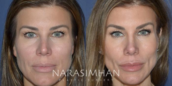 Before & After Rhinoplasty Case 330 Front View in Tampa, Florida