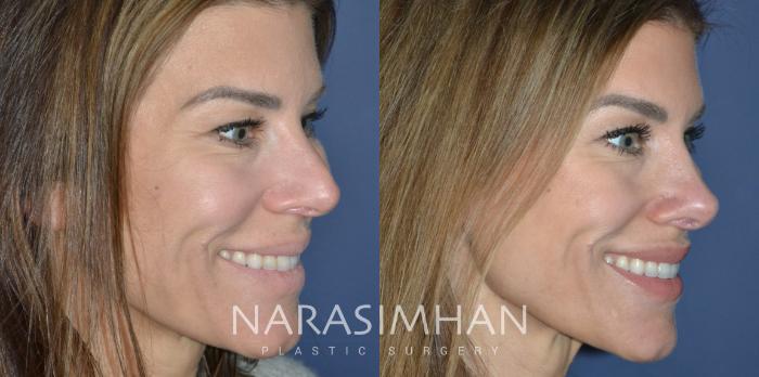Before & After Rhinoplasty Case 330 Right Oblique View in Tampa, Florida