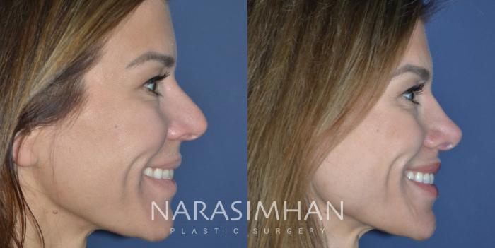Before & After Rhinoplasty Case 330 Right Side View in Tampa, Florida
